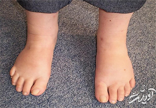 علائم سکته قلبی؛ ۱۲ نشانه ساده اما مرگبار